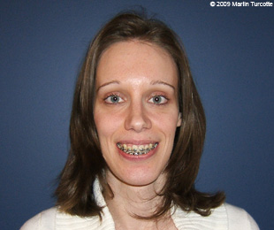 Marie-Hélène Cyr - After orthognathic surgeries (February 9, 2009)